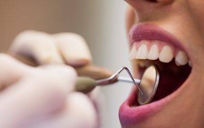 🦷 Prótesis Fijas vs. Prótesis sobre Implantes: ¿Cuál es la mejor opción para cada caso?