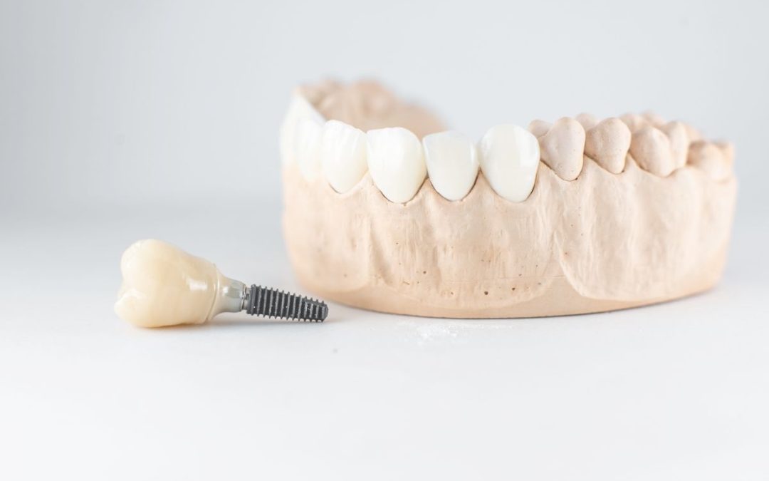 Beneficios de las prótesis sobre implantes: salud, estética y calidad de vida para tus pacientes