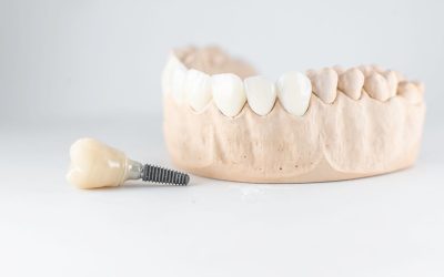 Beneficios de las prótesis sobre implantes: salud, estética y calidad de vida para tus pacientes