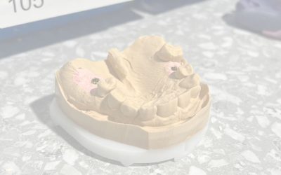 Indicadores clínicos para elegir el protocolo de carga inmediata