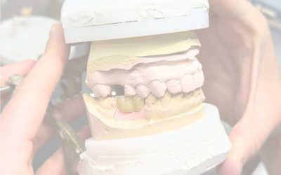 ¿Qué es la oclusión en prótesis dental y por qué es clave para el éxito de una rehabilitación?