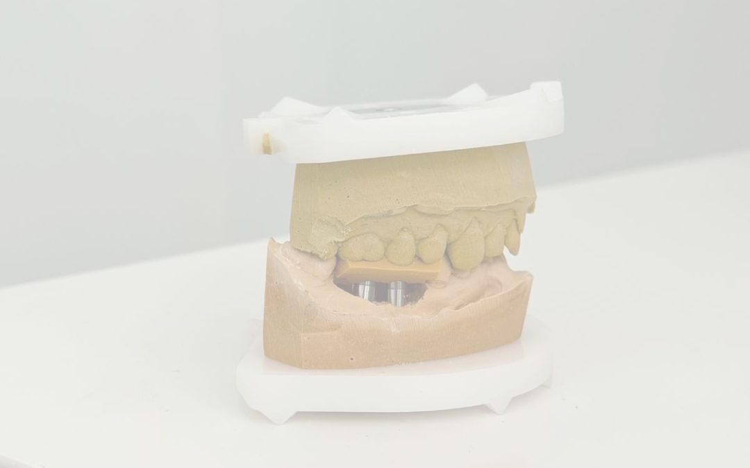 Registro de mordida en prótesis sobre implantes: importancia para el ajuste y la estabilidad del tratamiento