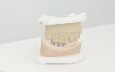 Registro de mordida en prótesis sobre implantes: importancia para el ajuste y la estabilidad del tratamiento